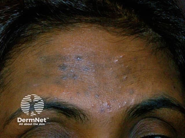 Low-Fluence Q-Switch Laser and Tranexamic Acid Can Quickly Treat Postinflammatory Hyperpigmentation