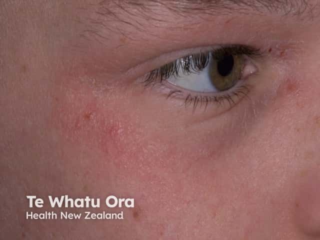 <![CDATA[Castle Biosciences Launches 487-Gene Test for AD Care]]>