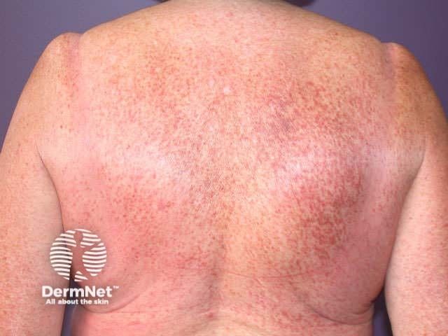 FDA Accepts Bezuclastinib NDA for Advanced Systemic Mastocytosis