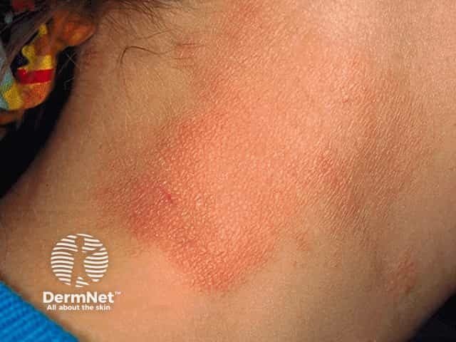 Dermatologic Evaluation Leads to Early Detection of Breast Cancer Metastasis