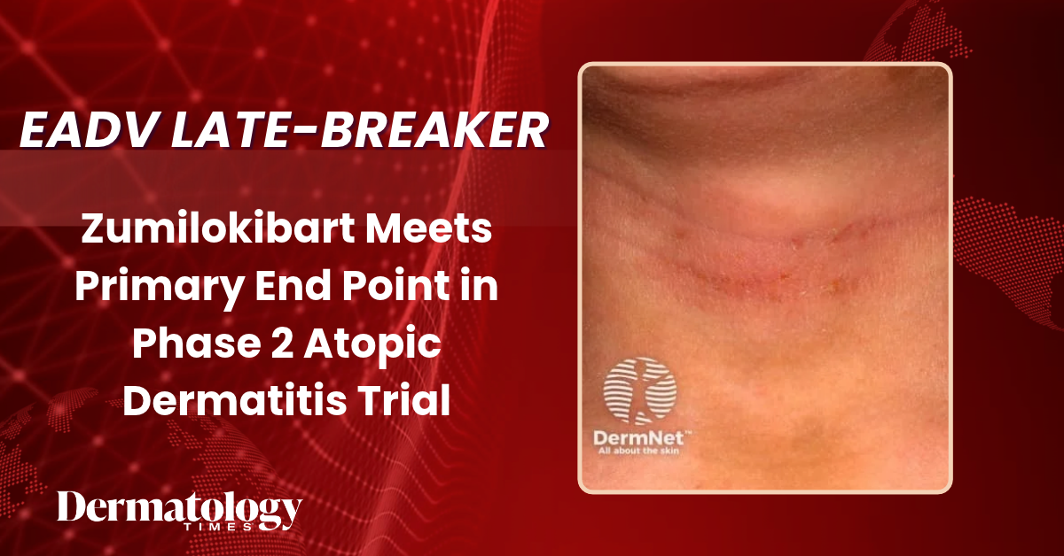Late Breaking: Zumilokibart Meets Primary End Point in Phase 2 Atopic ...