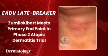 Late Breaking: Zumilokibart Meets Primary End Point in Phase 2 Atopic Dermatitis Trial