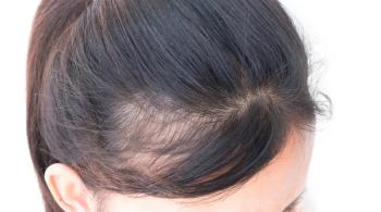 alopecia
