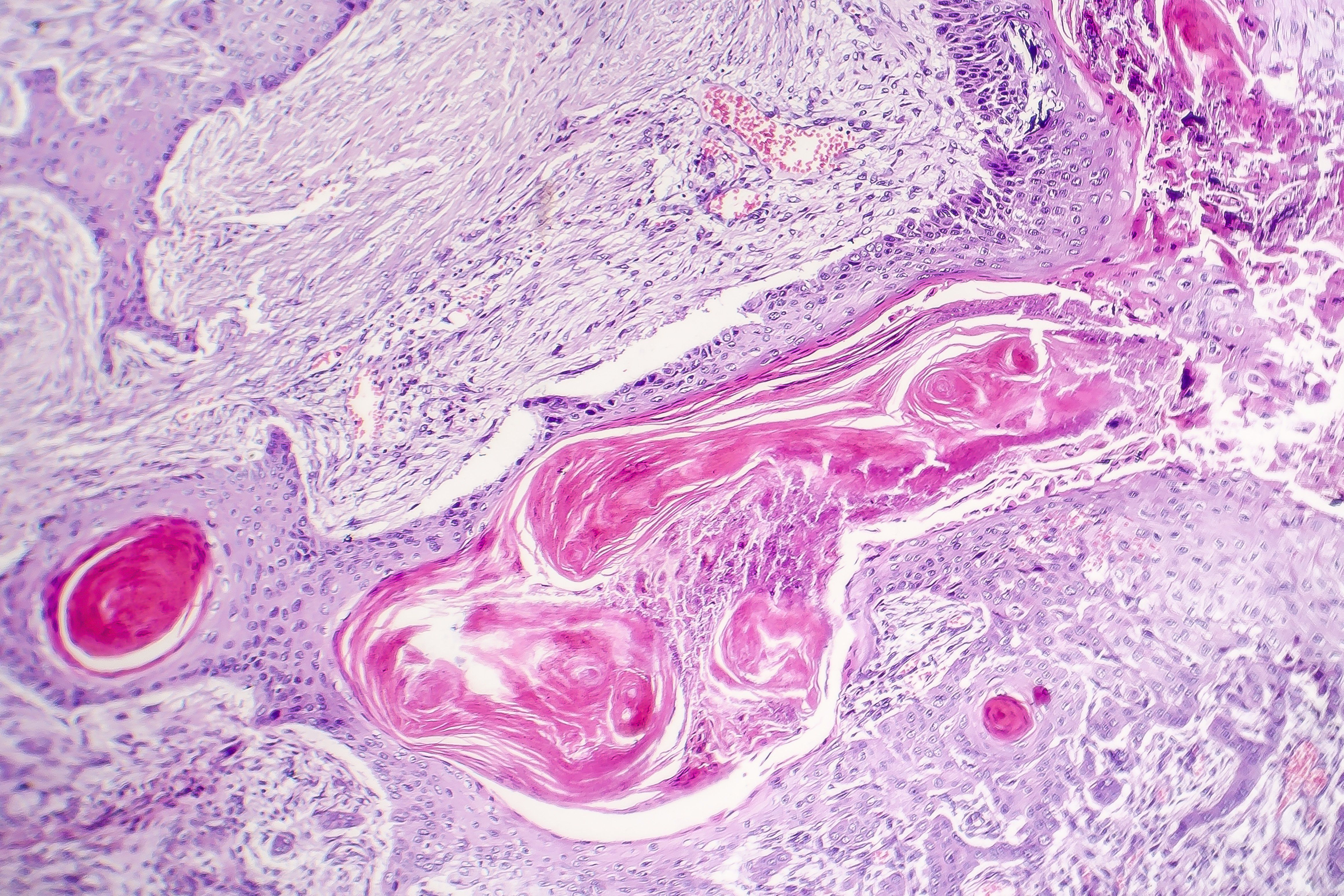 Invasive Squamous Cell Carcinoma Skin Cancer
