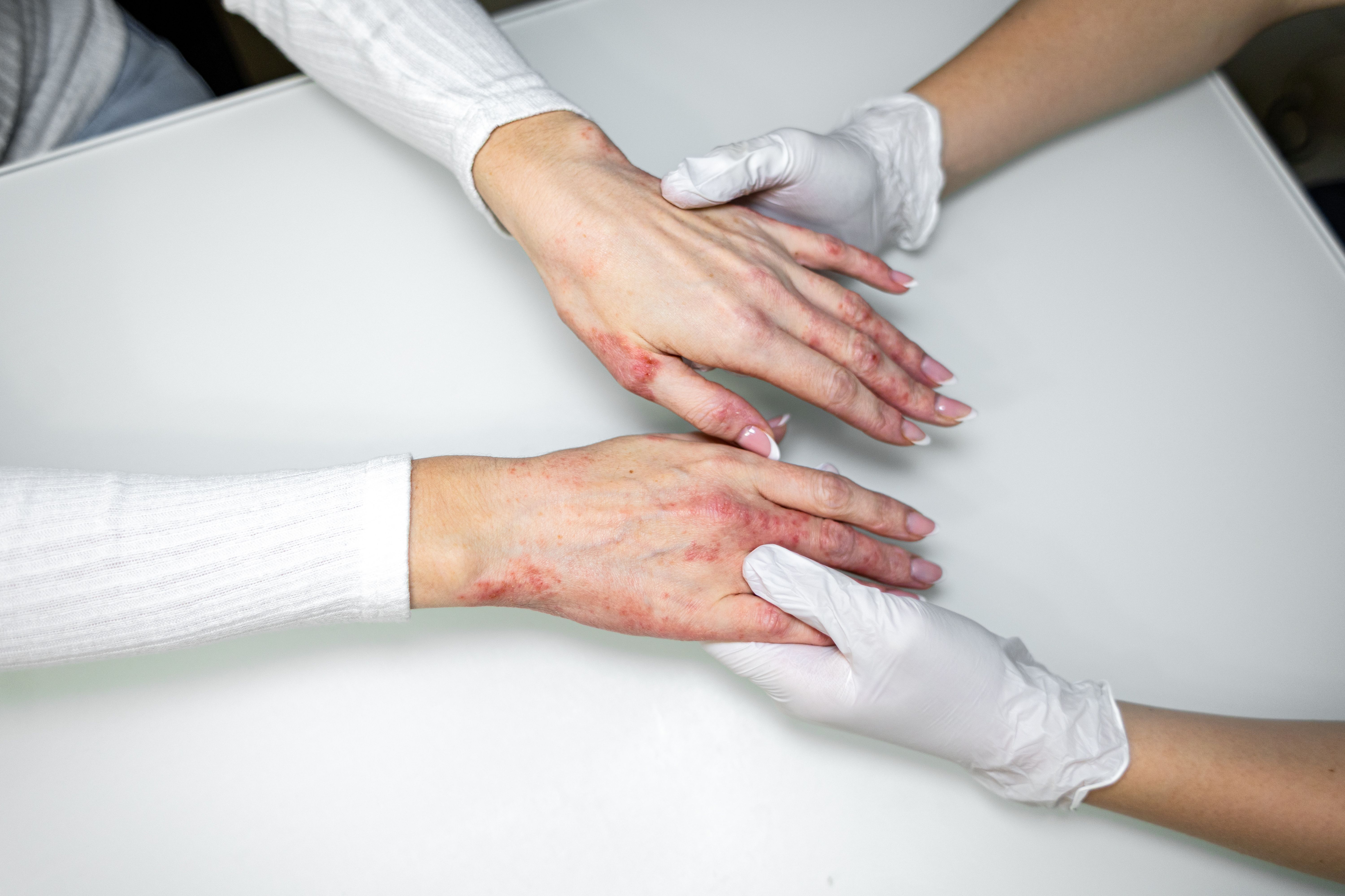 Envudeucitinib Shows Durable Skin Clearance in Phase 3 Psoriasis Extension