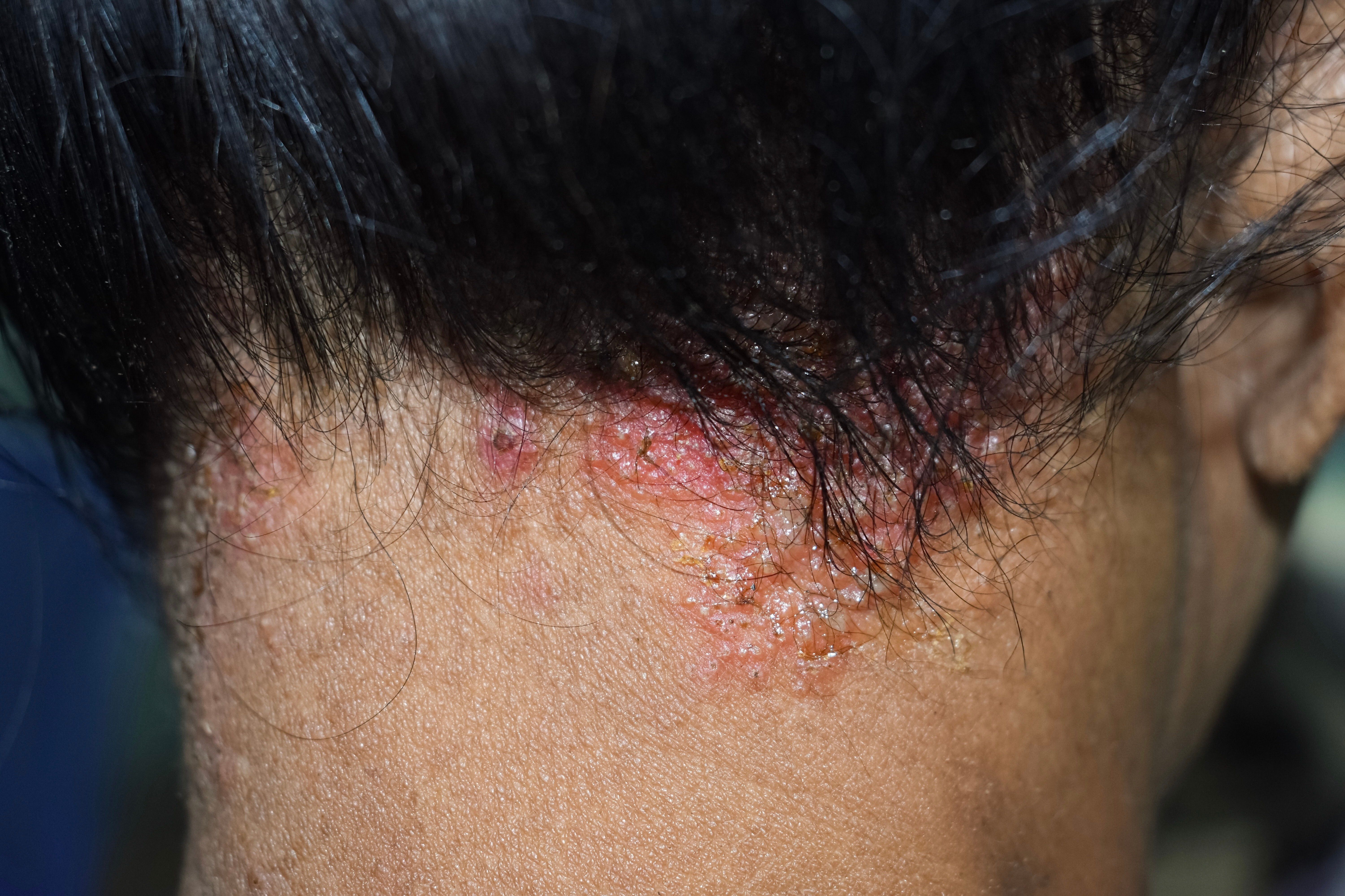 Dermatitic Study Reveals HCPs Underestimate Burden of Disease Associated With ...