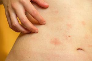 The Gut-Skin Axis: New Evidence Links Microbiota to Skin Disease via Inflammatory Cytokines