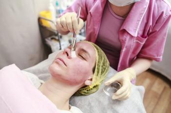 chemical peel procedure