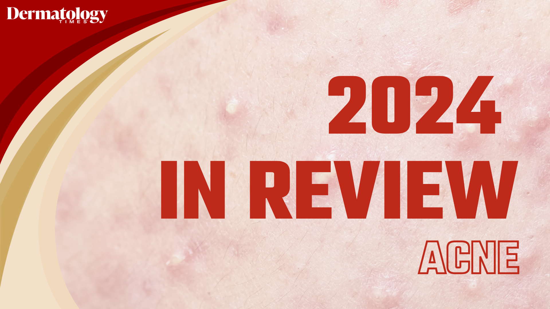 Dermatology Times 2024 In Review: Acne