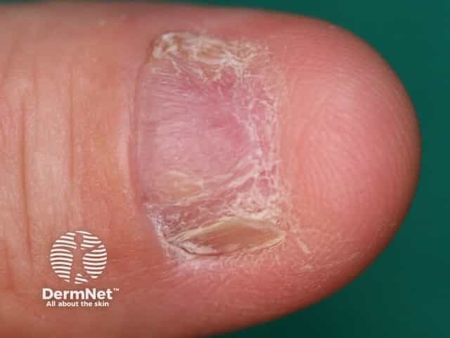 Nail Findings in Children Can Signal Systemic Disease, Review Finds
