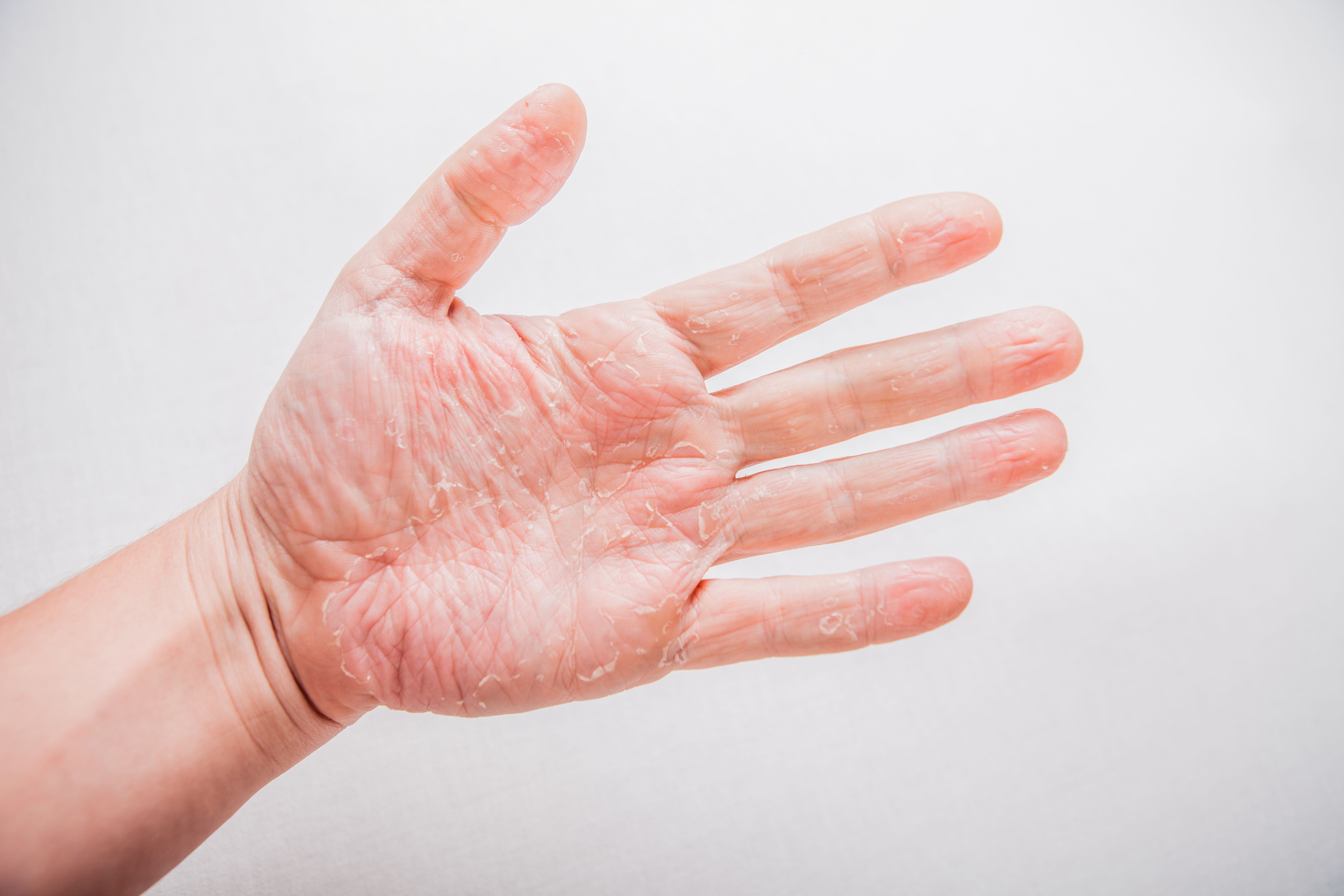 New Survey By LEO Pharma and Ipsos Highlights Diagnostic, Treatment Gaps in Chronic Hand Eczema