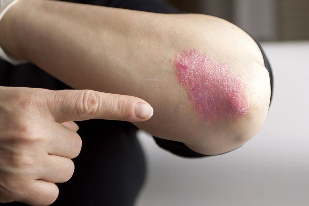 Psoriasis elbow