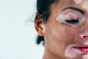 Talking to Children and Adolescents About Vitiligo