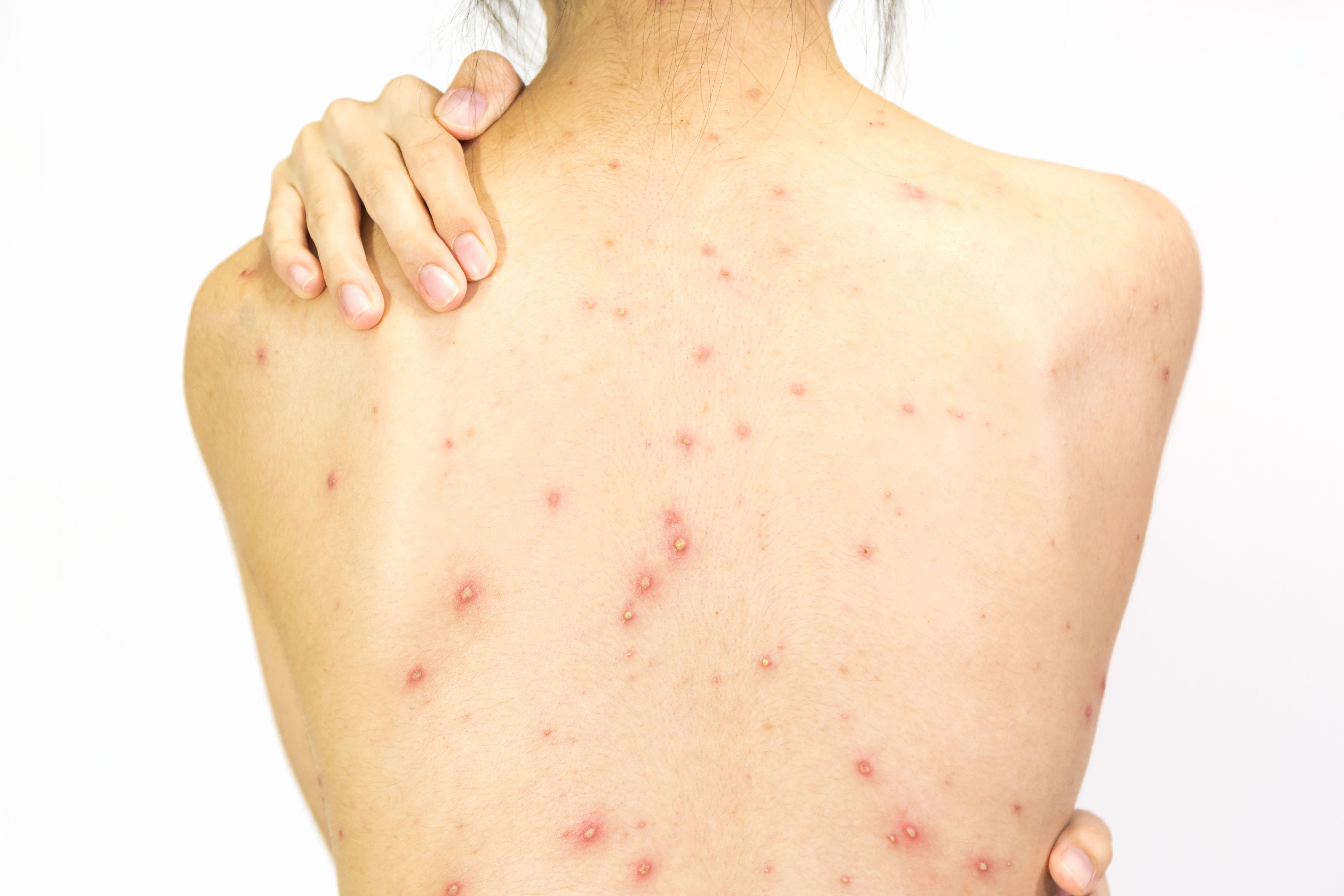 Severe back deals acne