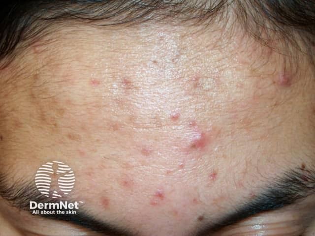 Biofrontera Completes Ameluz Phase 2b Trial for Moderate to Severe Acne