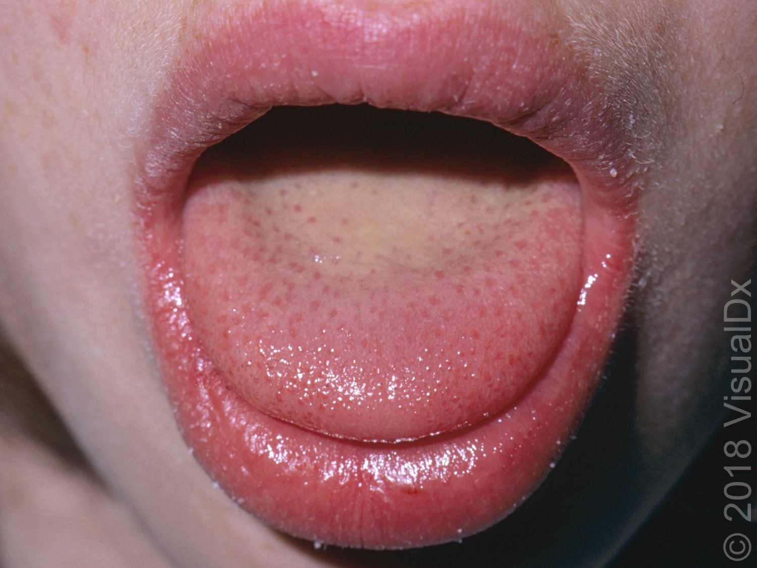 Image IQ: An 8-year-old girl with a sore throat, deep red tongue, fever and a petechial rash.