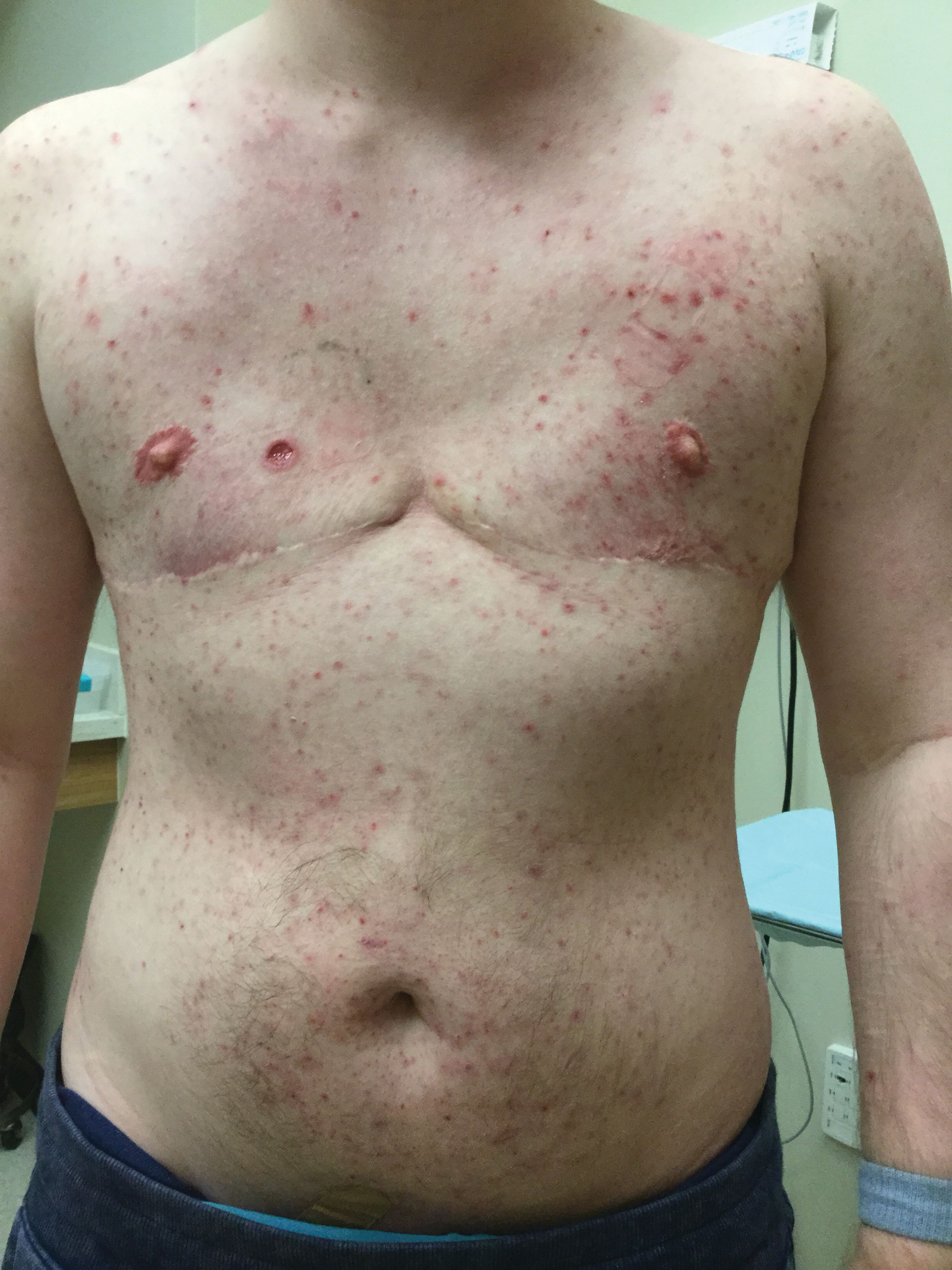 Widespread erythema, comedones, and large excoriated lesion on right breast