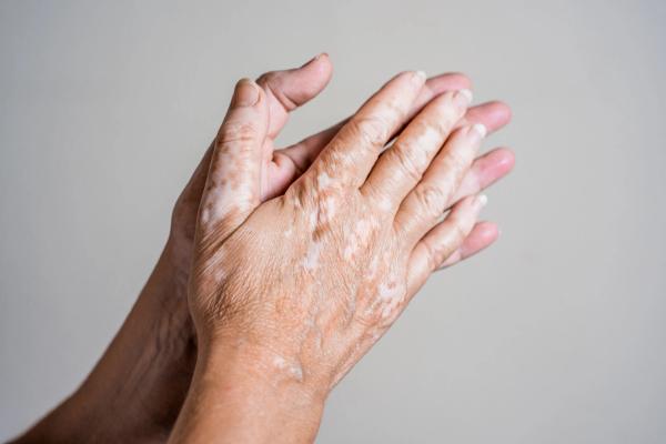 Phase 1b Trial of FB102 Demonstrates Significant Facial Repigmentation and Sustained Vitiligo Response