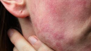 New Consensus Defines Remission, Disease Activity in Atopic Dermatitis