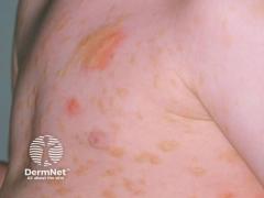 EP. 7 Improving Recognition and Management of Systemic Mastocytosis