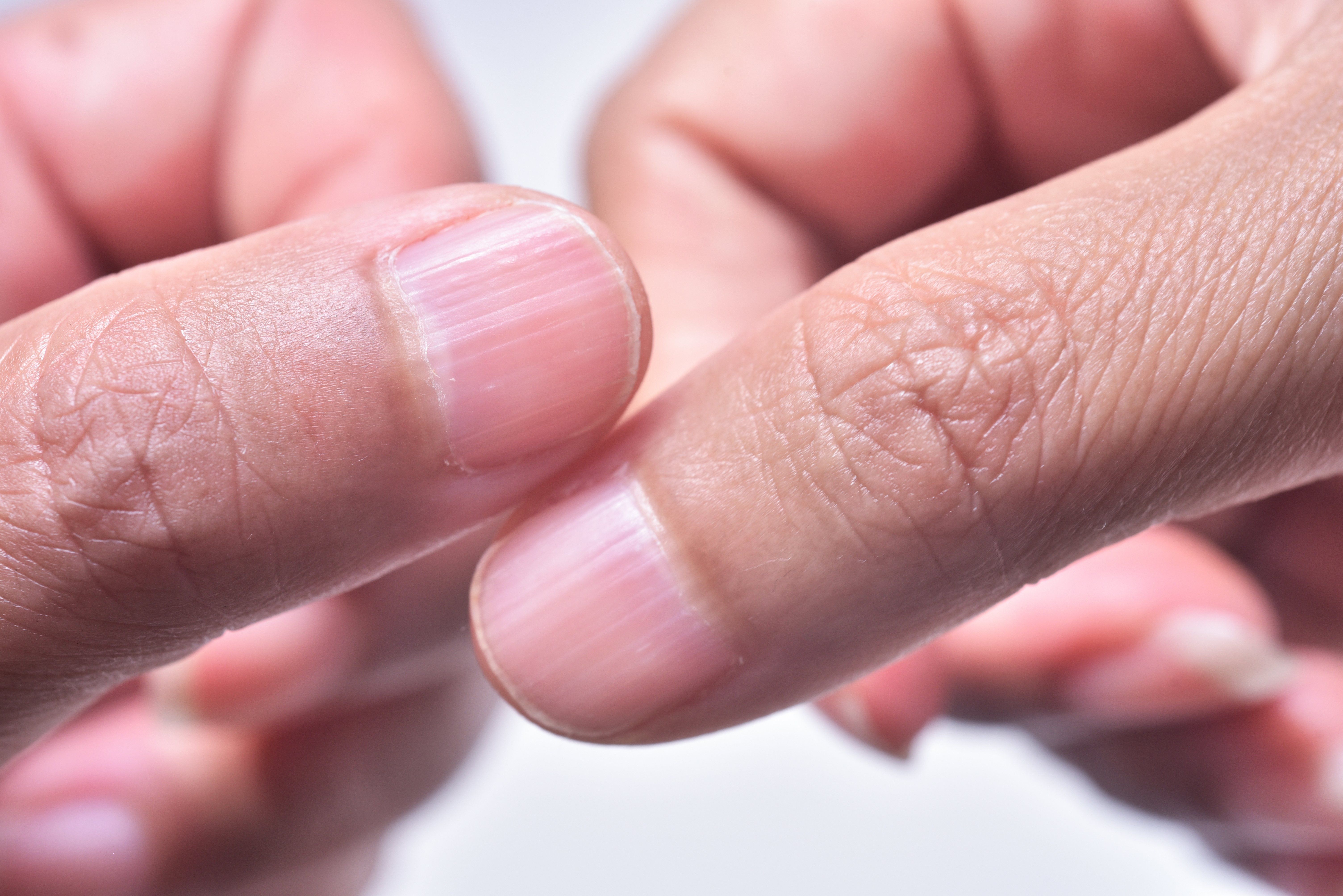 Tips on treating nail problems