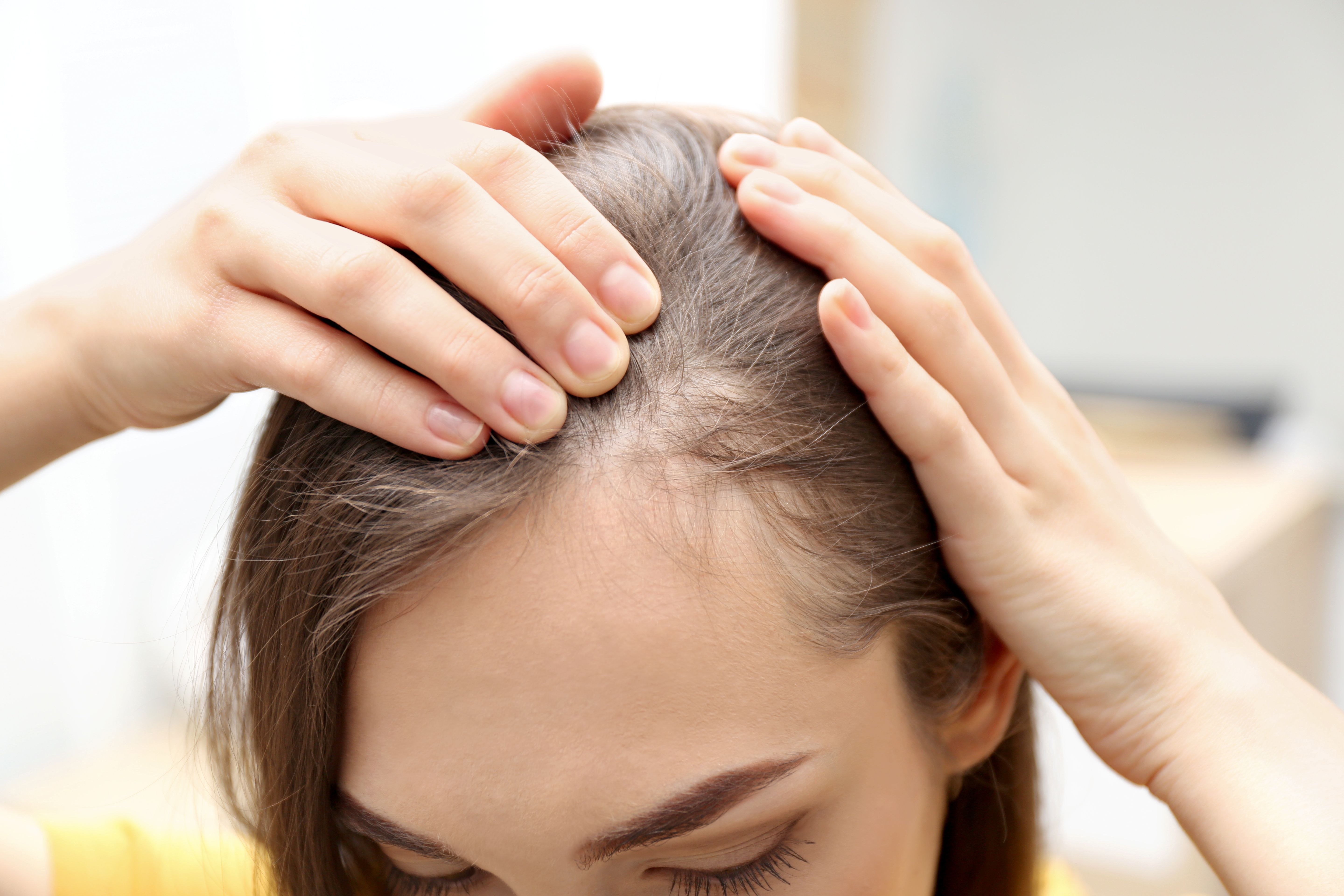 How to Diagnose and Manage Alopecia Areata - Dermatology Times