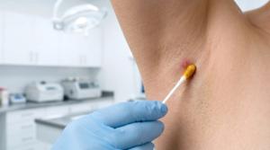 Lutikizumab Meets Primary End Point in Phase 3 HS Trial