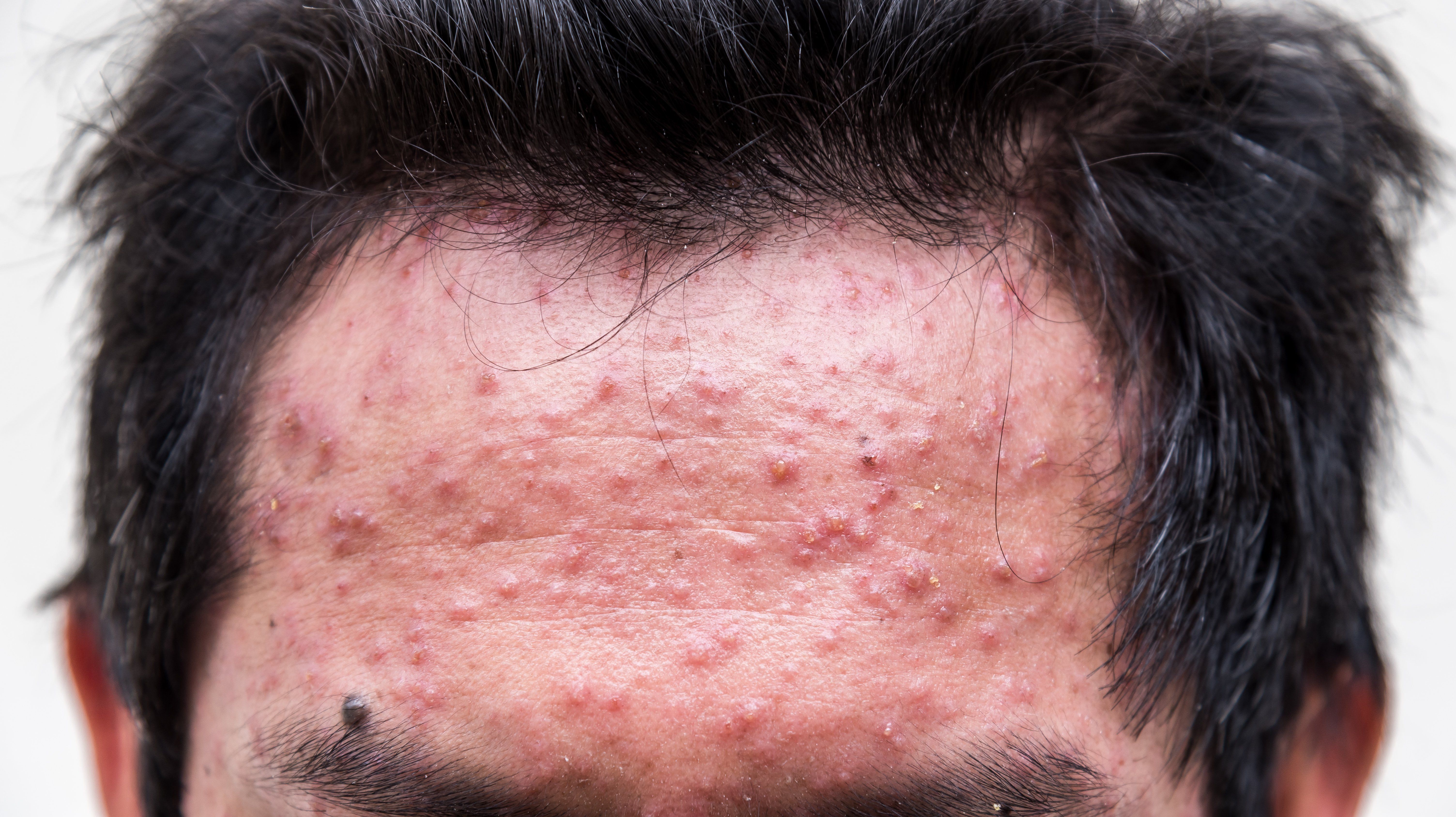 A Paradigm Shift In The Treatment Of Acne Dermatology Times And Multimedia Medical Llc
