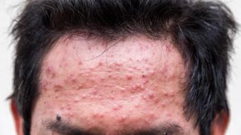 Acne or forehead