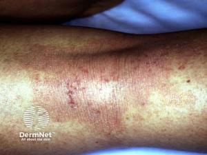 Kymera Completes BROADEN2 Enrollment for KT-621 in Atopic Dermatitis