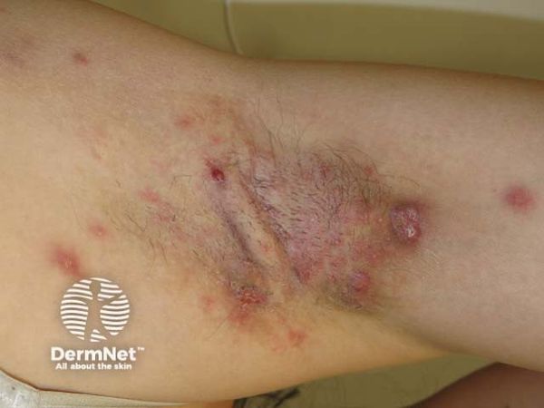 UCB Presents 3-Year BE HEARD Trial Results for Bimekizumab in Moderate-to-Severe HS