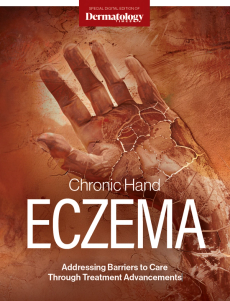Chronic hand eczema