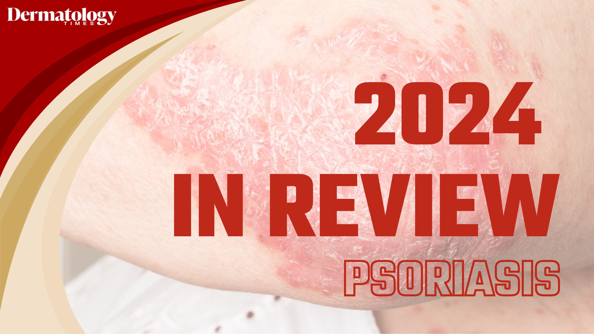 Dermatology Times 2024 in Review: Psoriasis