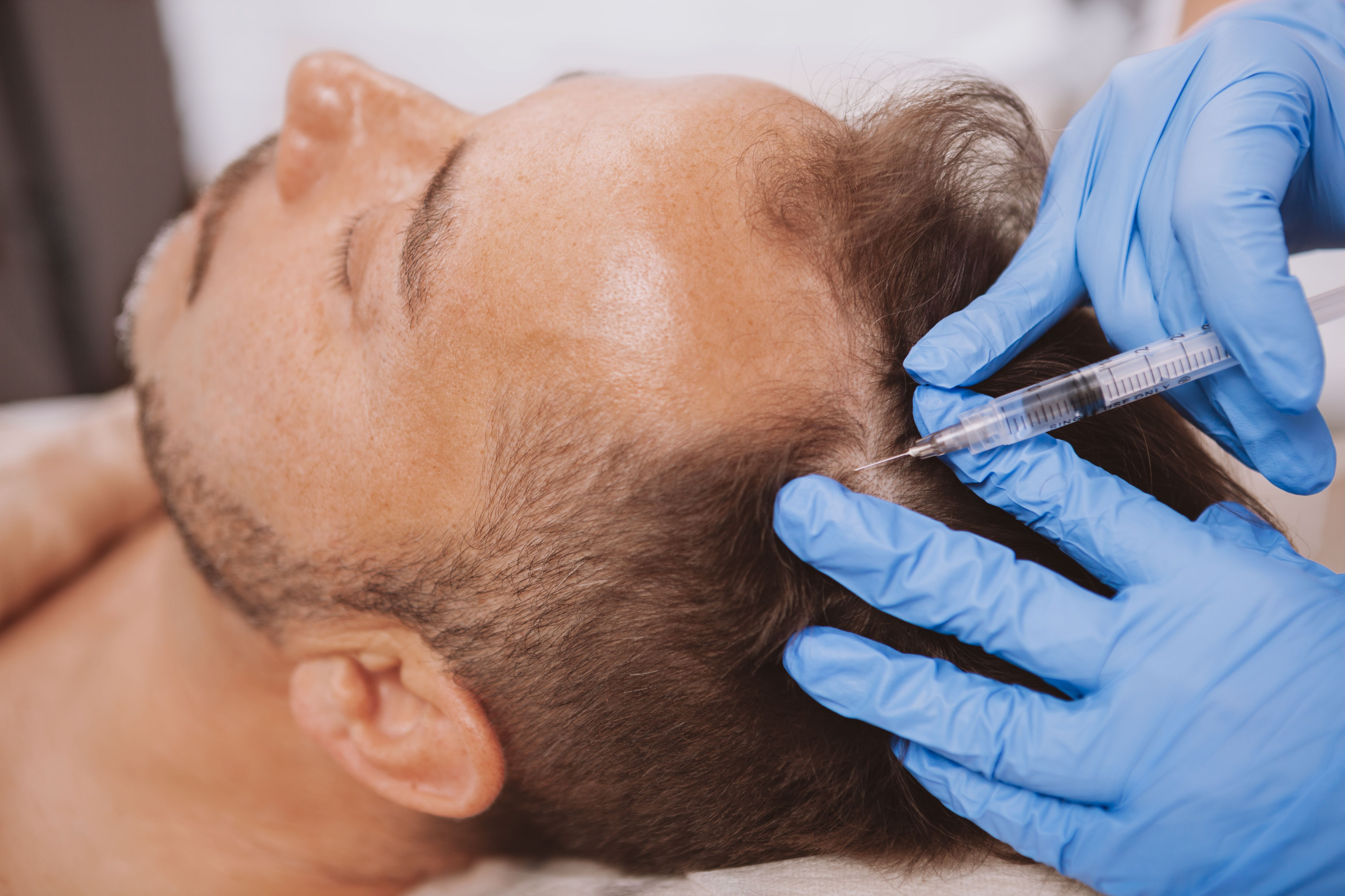 Platelet-Rich Plasma in Hair Transplantation Shows Success in Patients with Androgenetic Alopecia