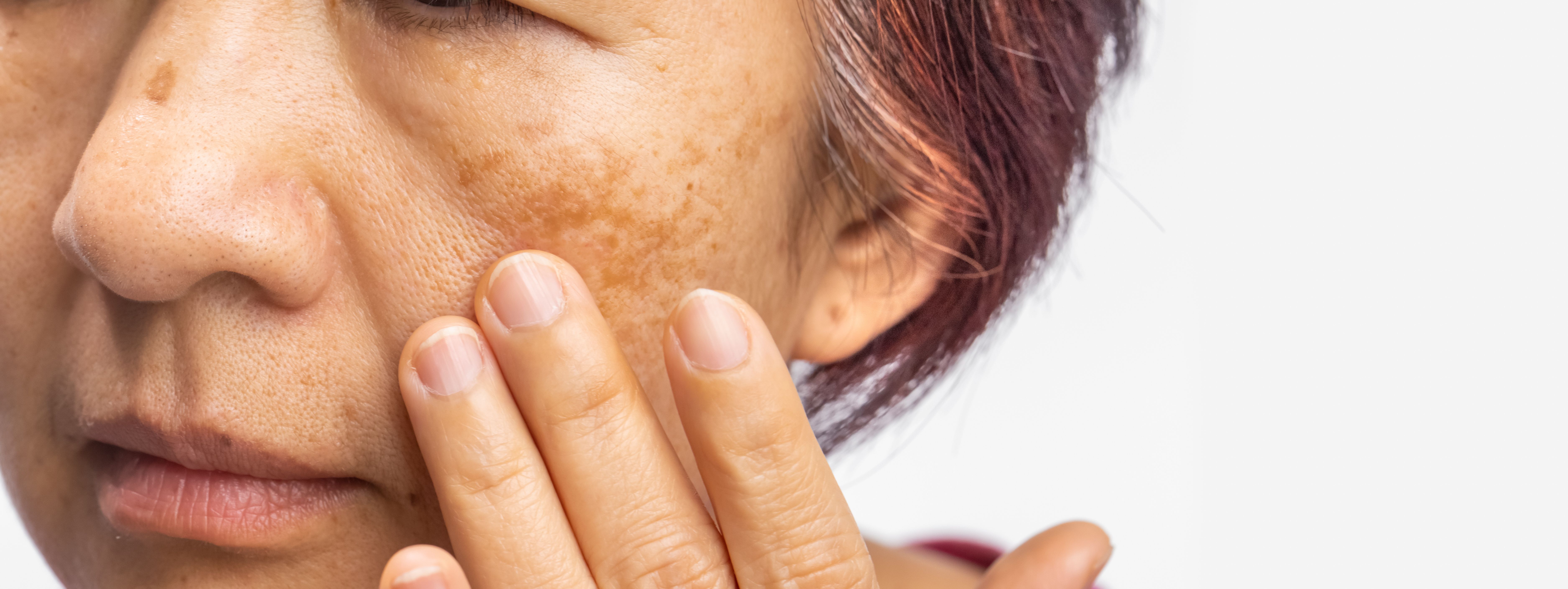 Pilot Study Finds Intradermal Botulinum Toxin A Safe and Effective for Melasma