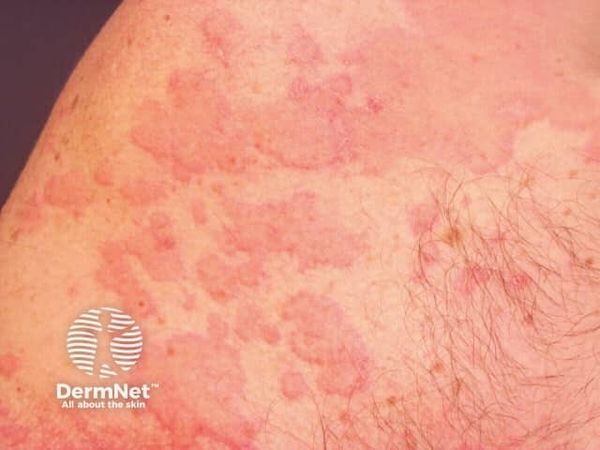 Tofacitinib Shows Promise in Omalizumab-Resistant CSU, New Case Series Finds