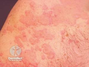 Biomarkers Bring Precision Closer in CSU Management