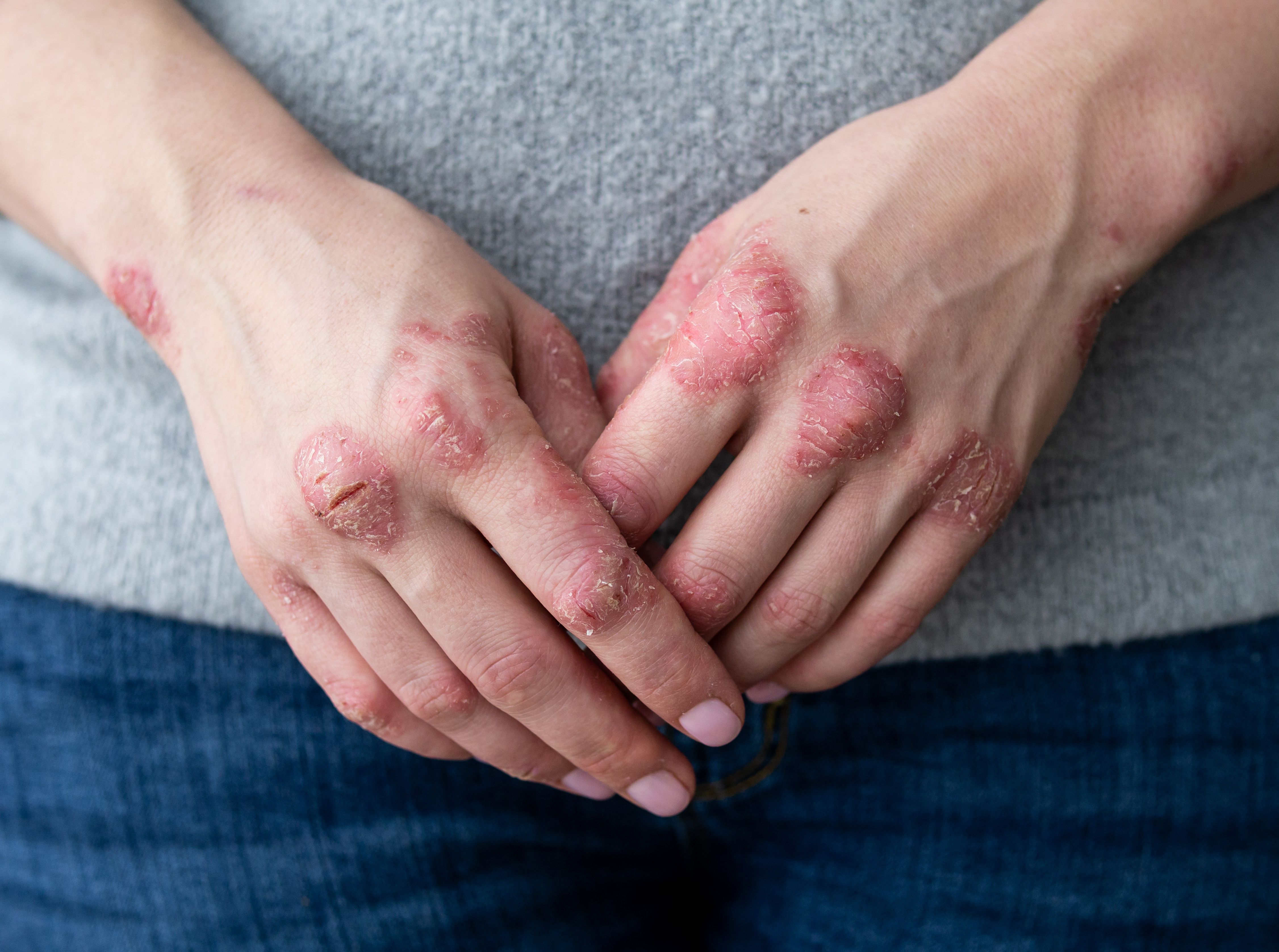 Efficacy Of Risankizumab For Severe Psoriasis