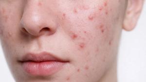 Efficacy and Hydration Benefits of a Barrier-Conscious Dermocosmetic Regimen for Acne