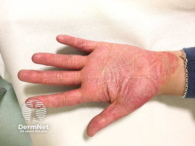 Phenotype Switching Between Psoriasis and AD Gains Clinical Ground in Biologic-Treated Patients