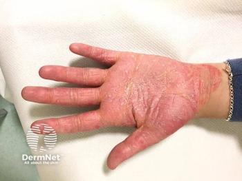 Phenotype Switching Between Psoriasis and AD Gains Clinical Ground in Biologic-Treated Patients