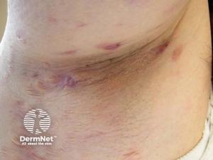 Hidradenitis Suppurativa: Immune Pathways and Evolving Interventions