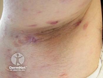 tirzepatide 10 mg reconstitution Injectable Tirzepatide tirzepatide 10 mg reconstitution Injectable Tirzepatide
