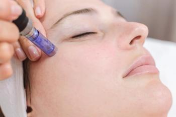microneedling