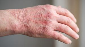 No Observed Skin Lesion Flares After Switching to Upadacitinib in Atopic Dermatitis