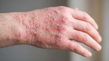 Upadacitinib Switch Linked to No Skin Flares in Atopic Dermatitis