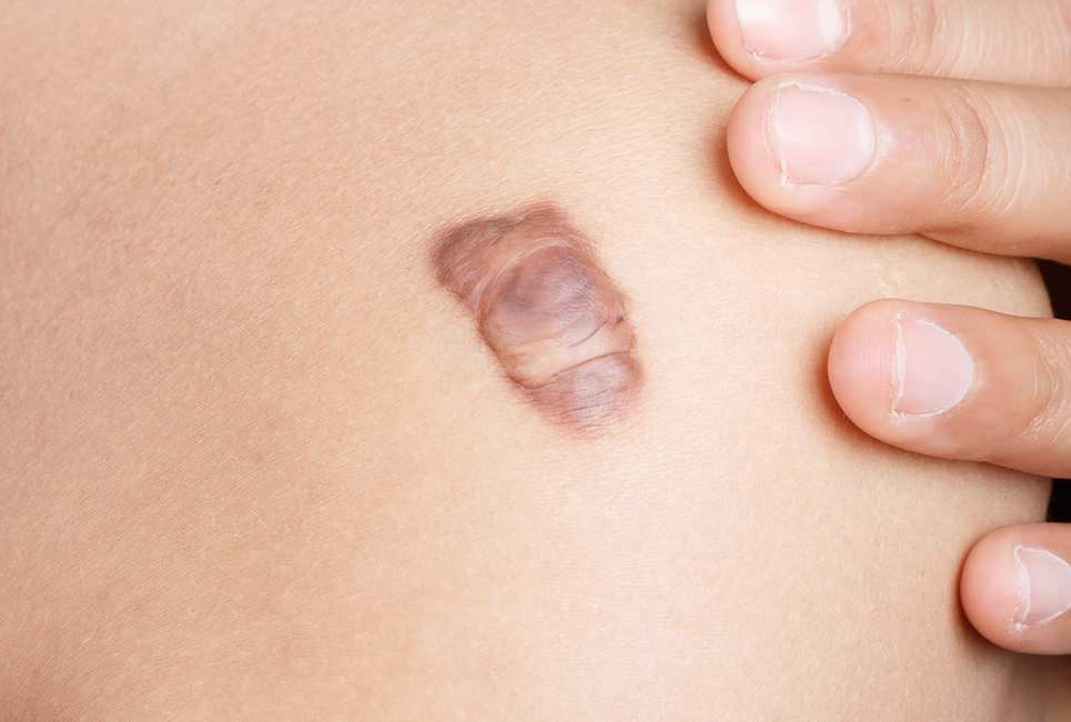 keloid scarring