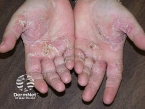Chronic Hand Eczema Linked to Lost Productivity and Lower Quality of Life