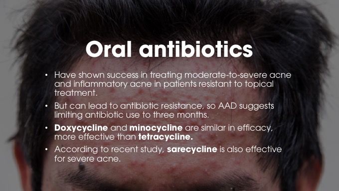 Oral antibiotics for acne 