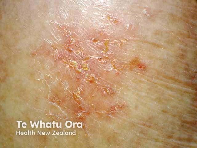 Molecular Insights Into ICI-Induced Skin Toxicities